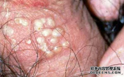 生殖器疱疹的危害都有哪些呢