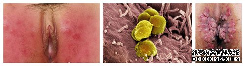 究竟什么是生殖器疱疹呢